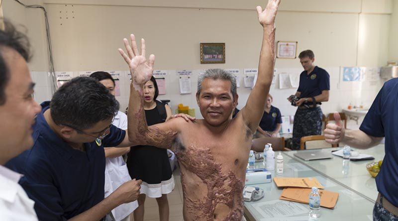 Royal Australian Navy Reserve Medical Officer and Plastic and Reconstructive Surgeon, Commander Ravi Mahajani conducts a pre-surgery consultation on a patient at Khan Hoa General Hospital in Nha Trang, Vietnam, during Exercise Pacific Partnership 2017. The patient could not lift his arm above his shoulder due to excessive scarring caused by severe electrical burns. Photo by Sergeant Ray Vance.